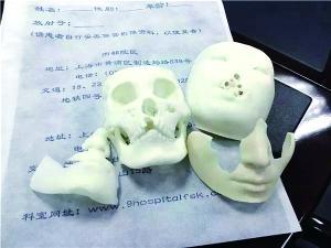 术前用3D打印技术还原模拟患者残缺的面部。