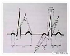 这几种心电图图示讲解，看完瞬间秒懂！