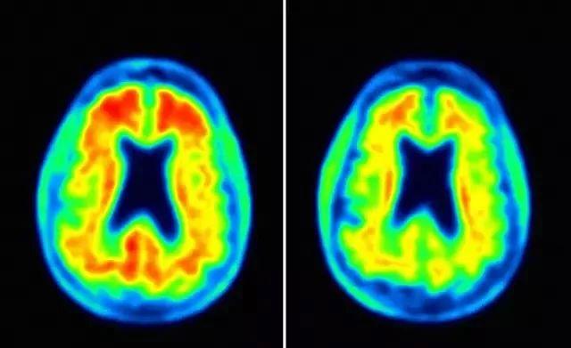 老年痴呆症有救了？首款阿尔茨海默病新药明年初申请上市