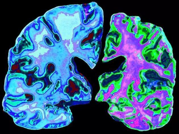 老年痴呆症有救了？首款阿尔茨海默病新药明年初申请上市