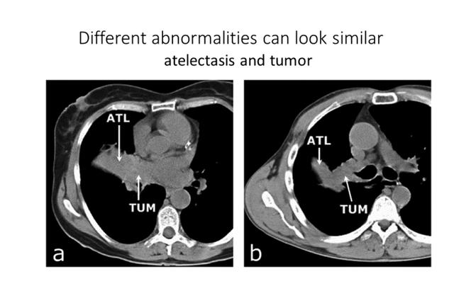 拍CT不再需要等医生诊断！AI自动出结果，放射科无人化迈出一大步