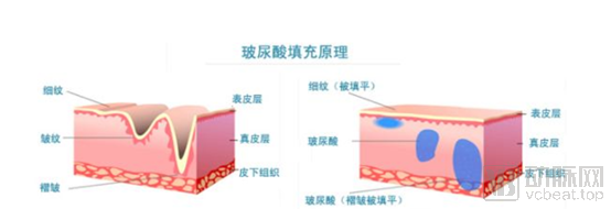 玻尿酸：医美中的茅台，一门百亿级的颜值生意