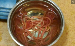 一名印度男子胃部发现大量蠕动蛔虫